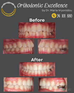 Orthodontic Excellence – Dr. Maria Vryonidou in Limassol